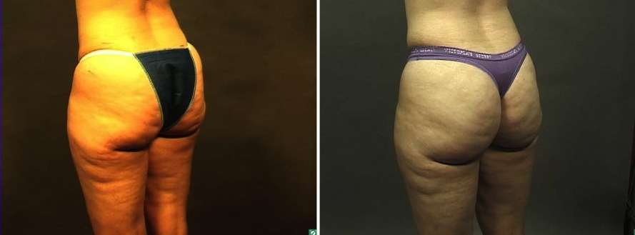 Liposuction Before and After Photos - Dallas, TX